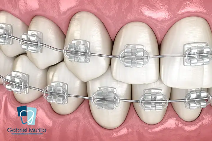 ortodoncia estética ortodoncia estética